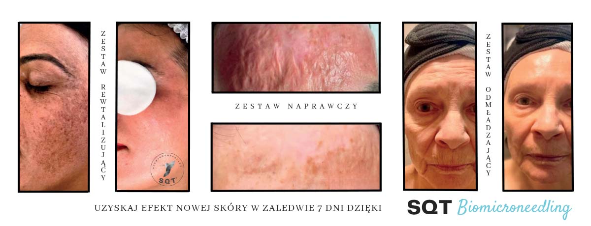 Rewolucyjne efekty SQT Biomicroneedling